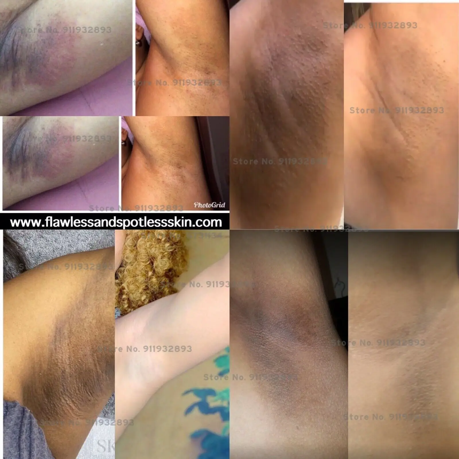 

Underarms Whitening, Underarms Cream, Inner Thighs, Neckline, Under Butt