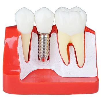 

4 Times Teeth Model Implant Analysis Crown Bridge Demonstration Teeth Model Dentist Tools Study Model