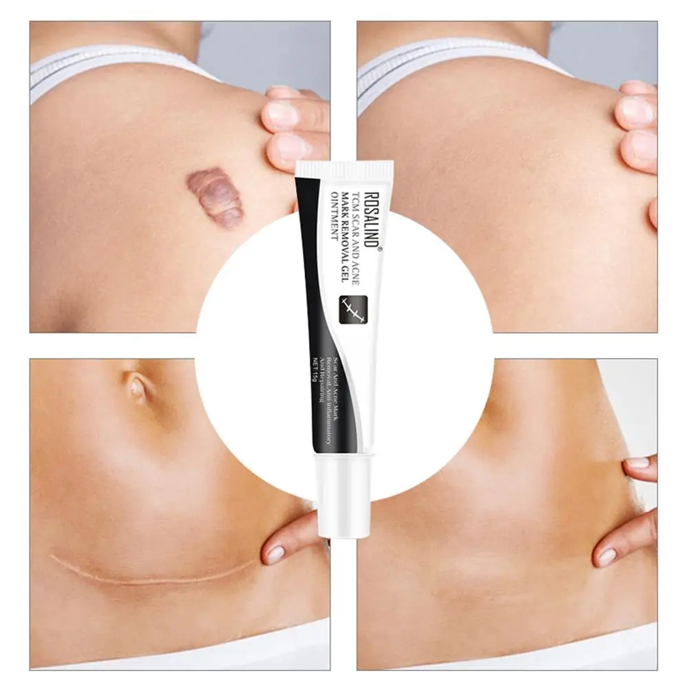 Repair Scar Cream Removal Acne Scars Gel Stretch Marks Surgical Scar Burn For Body Pigmentation Corrector 1 Repair Scar Cream Removal Acne Scars Gel Stretch Marks Surgical Scar Burn For Body Pigmentation Corrector 5