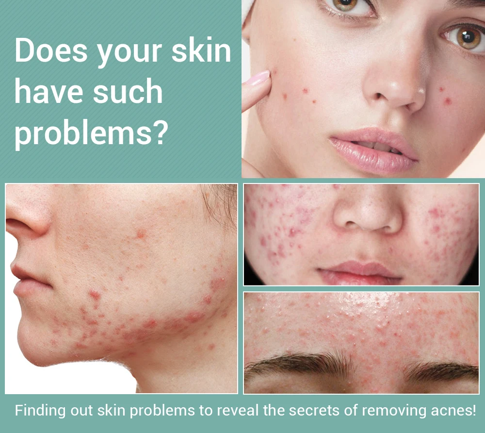 蓝蓓娜祛疤凝胶_01 (3)