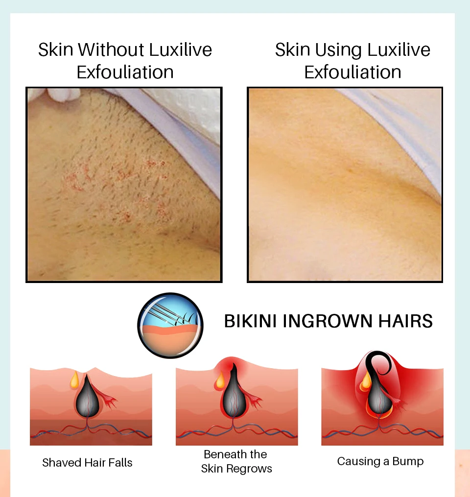 Stop Ingrown Hairs from Recurring  Nina LAllure