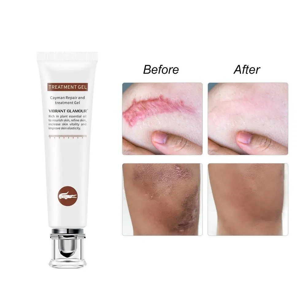 Scar Removal Cream Gel For Face Acne Scar Stretch Marks Remover Cream Skin Repair Face Cream For Burns Dilute Scars Skin