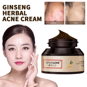

30g Ginseng Herbal Acne Removing Cream Acne Scars Blackhead Removal Cream Whitening Cream Skin Face Care Products TXTB1