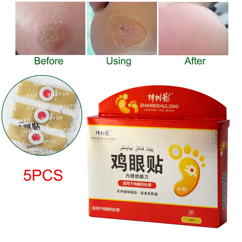 

High Quality 5 Pcs Medical Calluses Plantar Warts Thorn Plaster Warts Remover Pain Relief Patch Therapeutic Feet EK-New