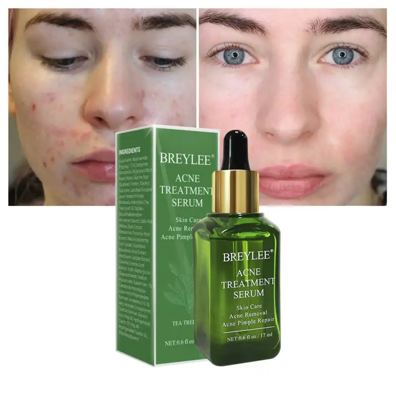 facial serum for acne