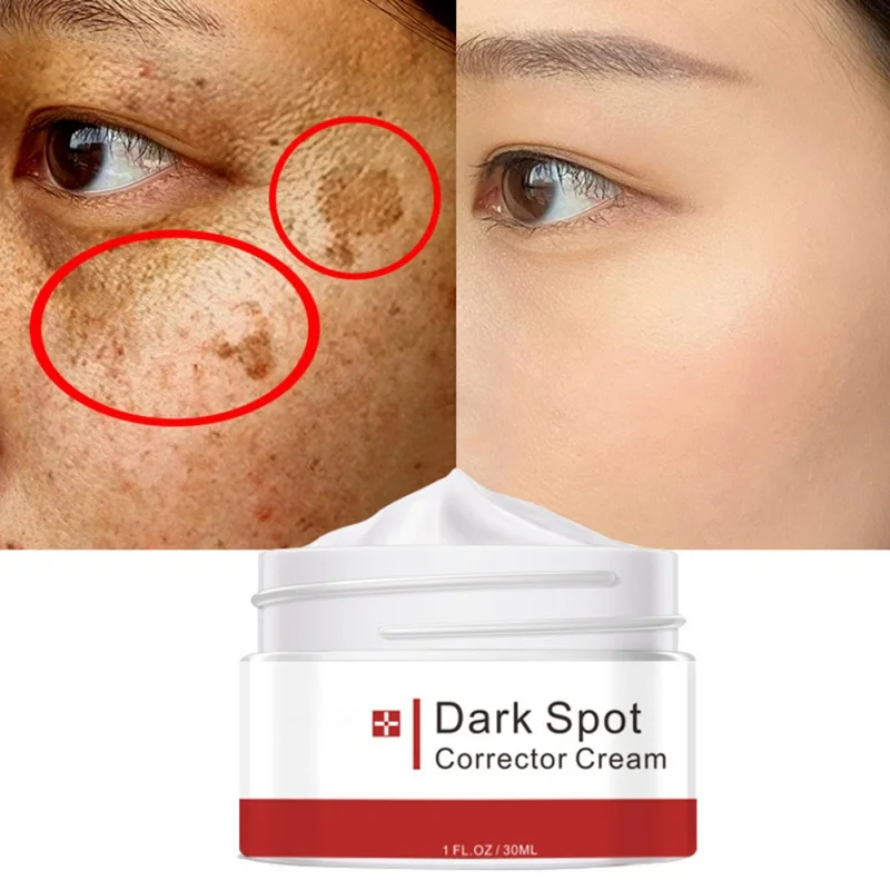 

Whitening Freckle Cream Remove Dark Spot Melasma Acne Spot Pigment Melanin Pigmentation Moisturizing Gel Skin Care Beauty Health