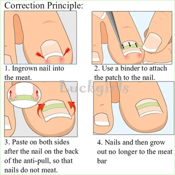 

1 Set Ingrown Toenail Sticker Elastic Toe Patch Straightener for Men Women