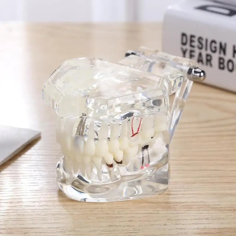 Горячая Распродажа модель зубного импланта для медицинского обучения уход за