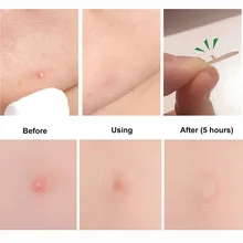 24 патча, невидимый, для удаления прыщей, пластырь для поглощения прыщей, эффективно впитывает прыщи, патчи для быстрого заживления