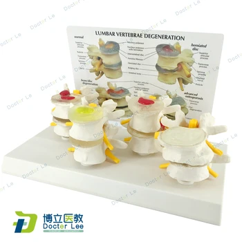 

4 Stages Normal and Disease Lumbar Vertebra Model Vertebrae Human Anatomy Skeleton for Medical Science Teaching