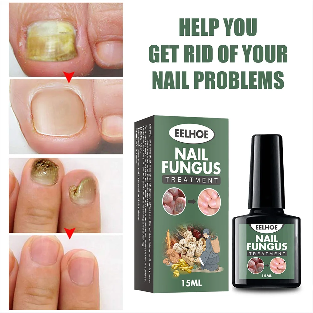 Extra Strong Nail Fungus Treatment USA Made With Tea Tree & Oregano Oil for  sale online | eBay