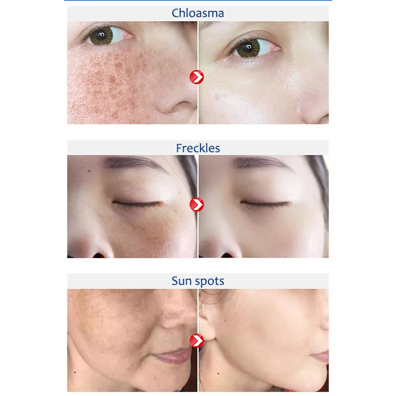 Skin Brightening Cream Freckle Cream Dark Spot Corrector Remover Removes Hyperpigmentation Reduces Melasma Lightens
