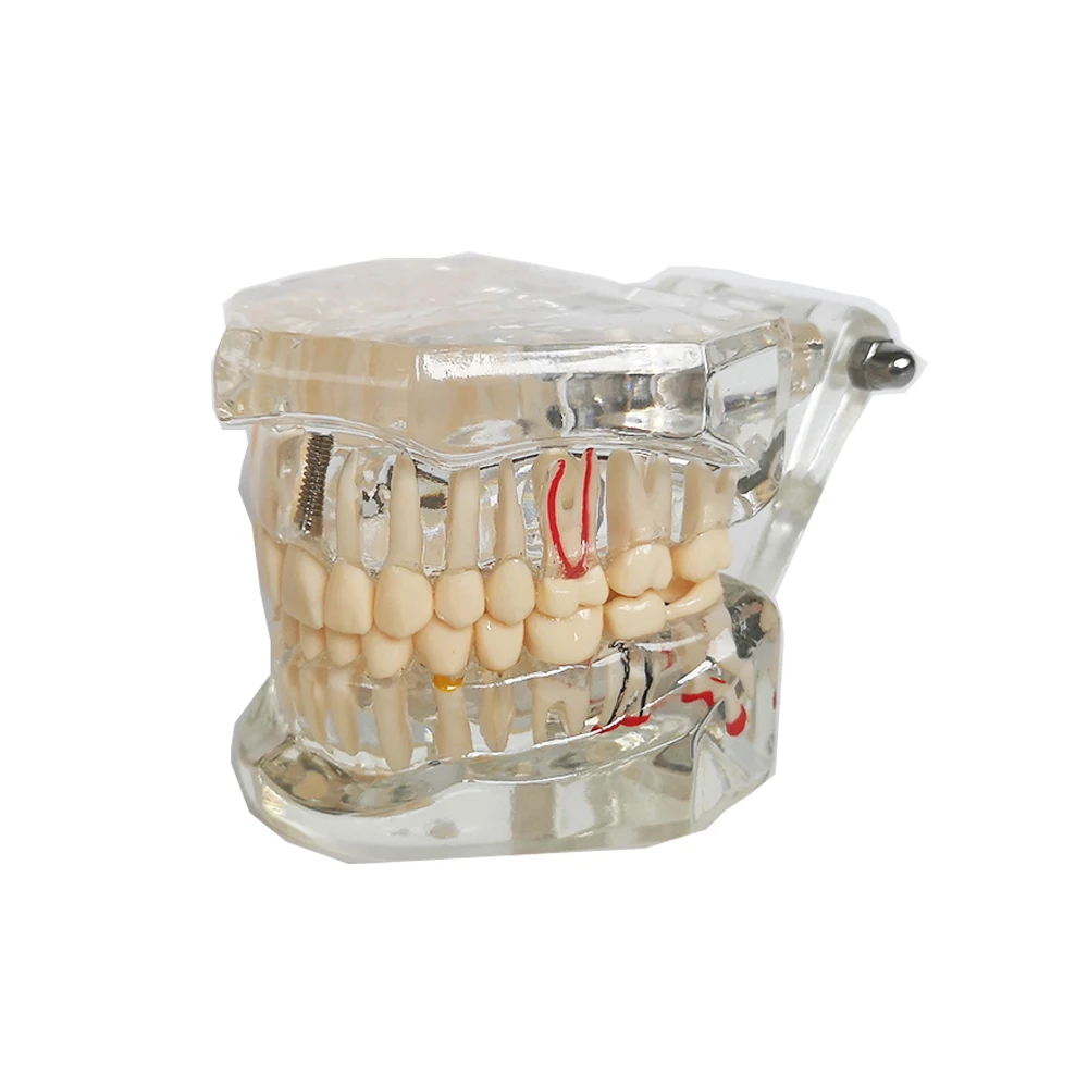 Nowy Model dentystyczny Implant zębów przywrócenie mostu nauczanie studium medycyna nauka choroba dentysta stomatologia produkty 6 Nowy Model dentystyczny Implant zębów przywrócenie mostu nauczanie studium medycyna nauka choroba dentysta stomatologia produkty 6