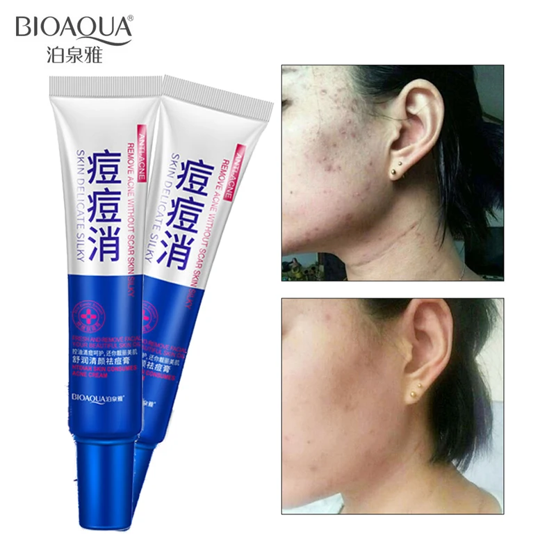

BIOAQUA Acne Treatment Skin Care Acne Cleaning Cream Remove Repair Comedone Pimple Acne Quickly Face Acne Cream Remover Anti