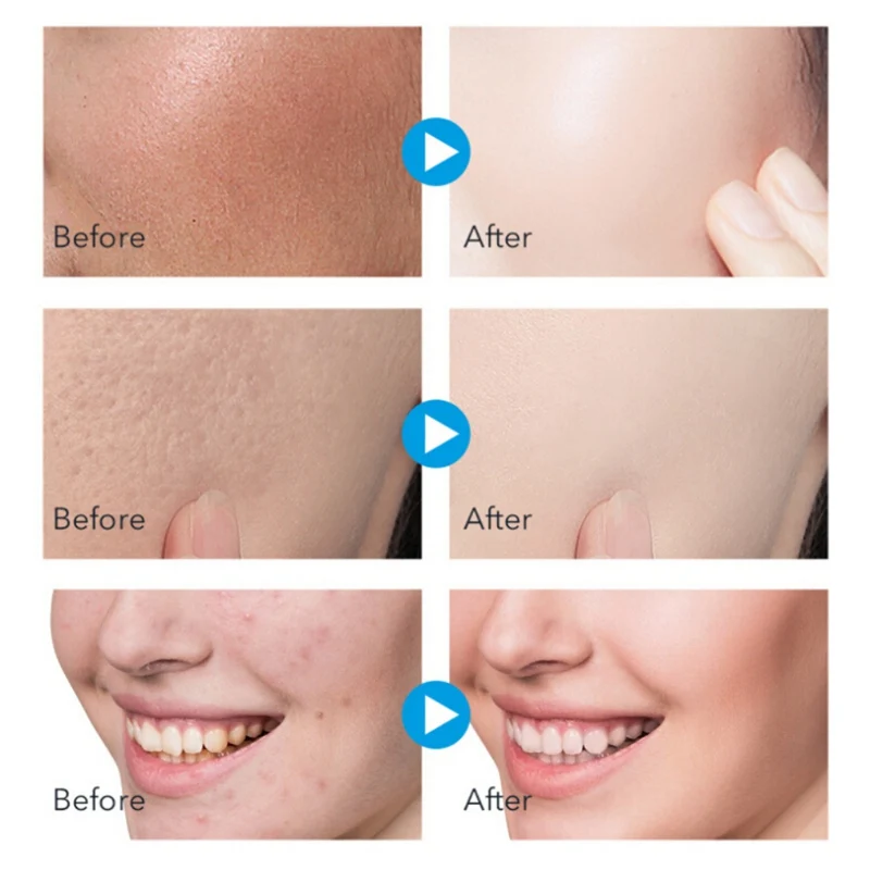 Recommend Face Exfoliating Mousse Face Peeling Shrink Pores Removal Blackhead Face Scrub Whitening Gel Exfoliators