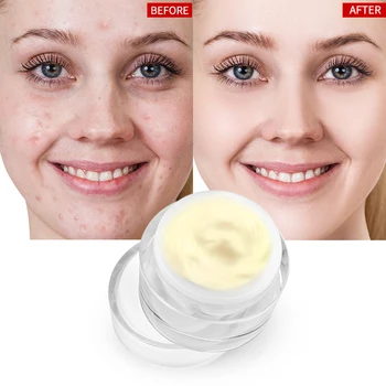 

AuQuest 15g Acne Cream Blackhead Repair Remova Oil Control Anti Acne Treatment Shrink Pores Face Repair Skin Care
