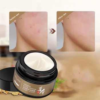 

Herbal Acne Cream Moisturizing Oil-control Remove Acne Shrinking Pores Anti-acne Cream