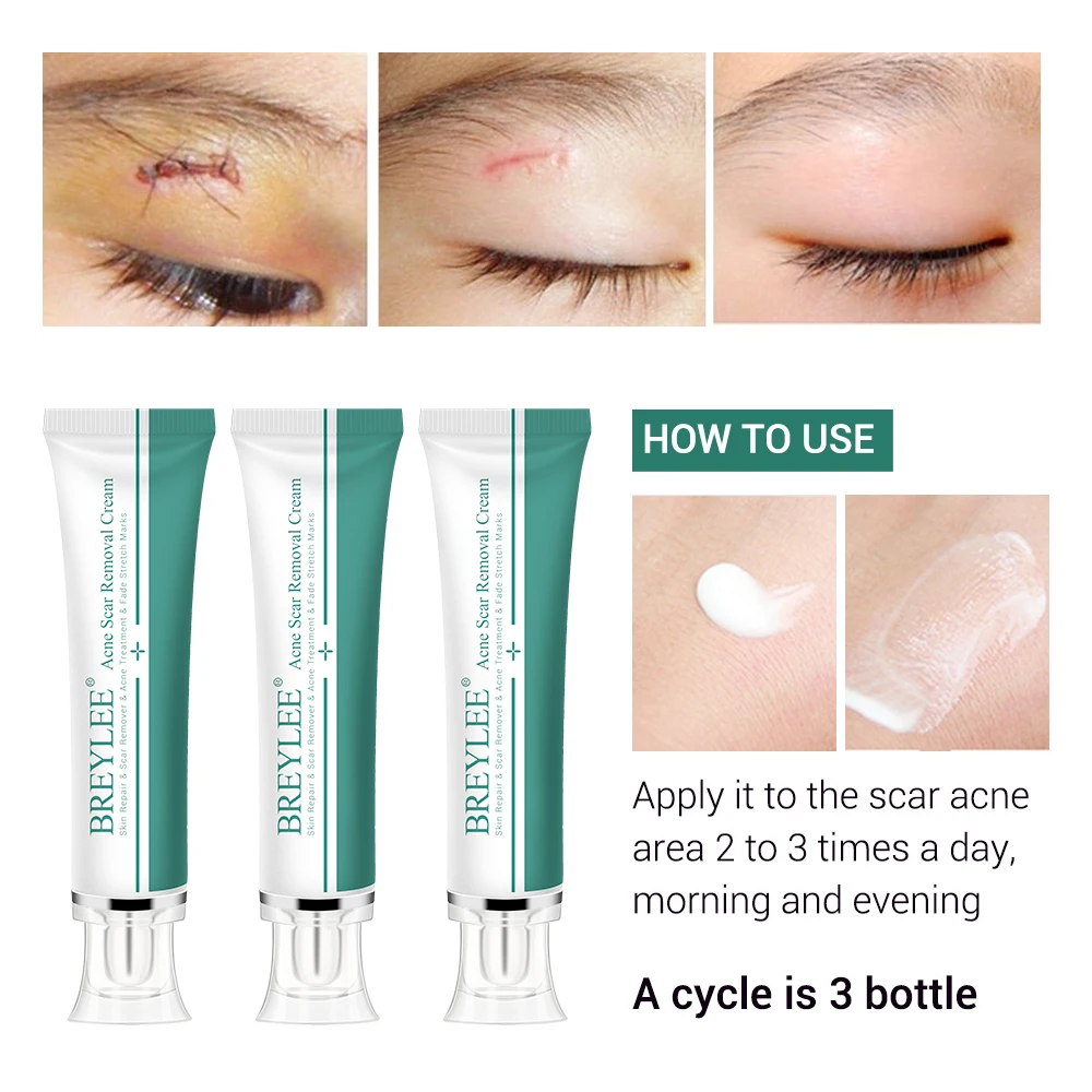 BREYLEE Acne Scar Removal Cream 30g Face Cream Skin Repair Skin Care Scar Acne Treatment Remove Stretch Marks Whitening Cream   (5)
