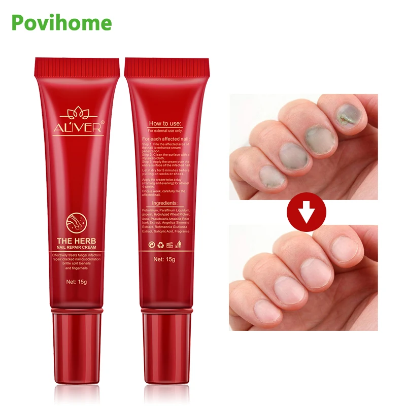 1pcs Fungal Nail Treatment Cream Foot Fungus Removal Gel Anti Infection Paronychia Onychomycosis Herbal Ointment Toe Care | Красота и