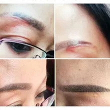 Сжигание/обжигание, хирургические ремонтные наборы шрамов, вогнутые/Выпуклые метки, стрии гравидарум, гипертрофические рубцы