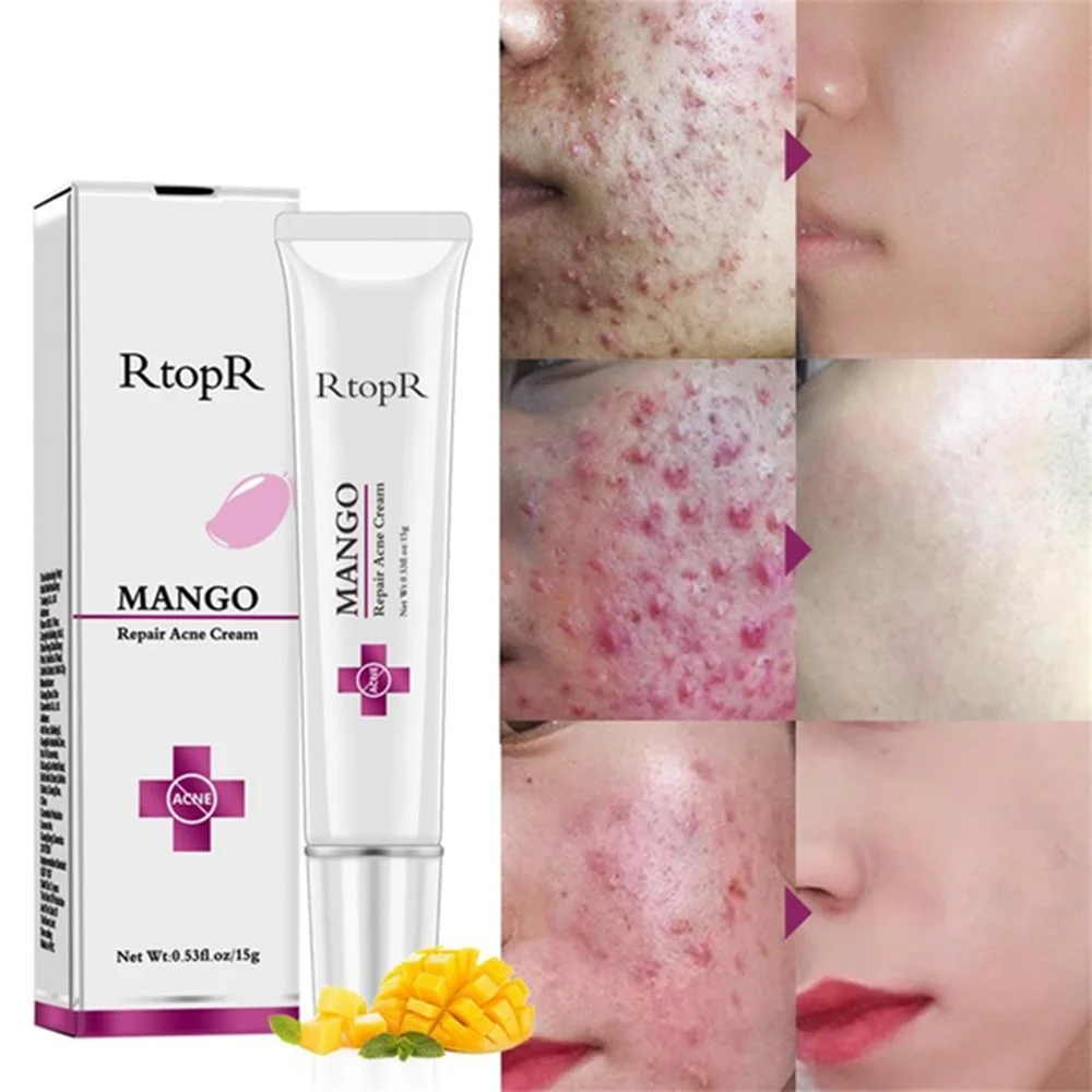 

RtopR Mango Acne Treatment Face Cream Blackhead Repair Gel Oil Control Shrink Pores Scar removal anti acne face cream Skin Care