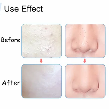 

New 3 pcs/set Acne Needle Tweezers Blackhead Pimples Removal Pointed Bend Gib Head Face Skin Care Tools Comedone Acne Extractor!