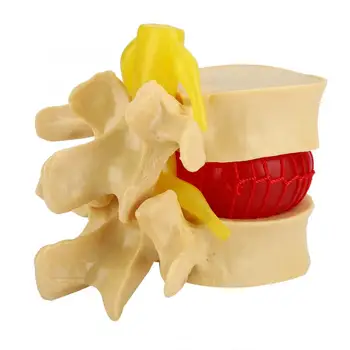 

1:1.5 Spine Lumbar Disc Herniation Demonstration Model Study Learn Human Spine Teaching Model