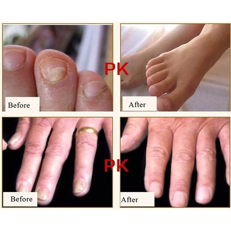 Высококачественная защита для ногтей крем для ухода за кожей грибок лечение травы противогрибковые крем для ремонта ногтей