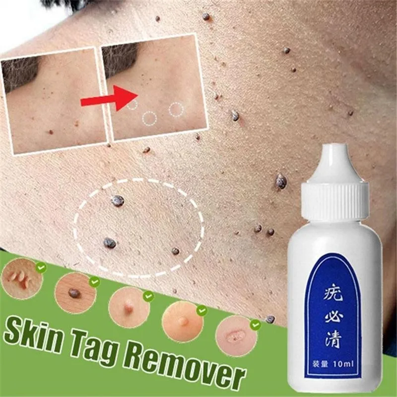 Skin Tag Remover Genital Wart Treatment Instant Removal Mole&ampPapillomas 10ML Natural Bacteriostatic Liquid Foot Corn Repair Tool | Красота