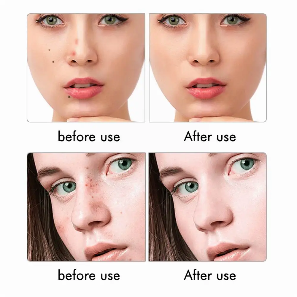 Laser de Remoção de Toupeira Remoção de Toupeira Cuidados com a Pele Removedor de Mancha Caneta Plasma Tatuagem Verruga Freckle Facial Remoção Tag Elétrica Escuro Pen 11 Pen Tatuagem Caneta Remoção de Toupeira Verruga