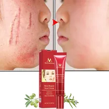 Крем для удаления шрамов от акне, восстанавливающий кожу, крем для лица, лечение прыщей, лечение угрей, отбеливающий крем против шрамов, растяжек, 15 г