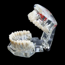 1 шт., зубная гигиена полости рта, имплантат, модель зубов для медицинского обучения, ПВХ/смола, уход за полостью рта, отбеливание зубов, модель зубов