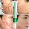 Effective Acne Removal Cream Herbal Acne Spots Oil Control Acne Cream Skin Care Whitening Moisturizing