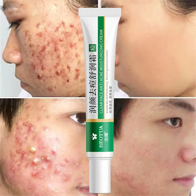Effective Acne Removal Cream Herbal Acne Spots Oil Control Acne Cream Skin Care Whitening Moisturizing Face