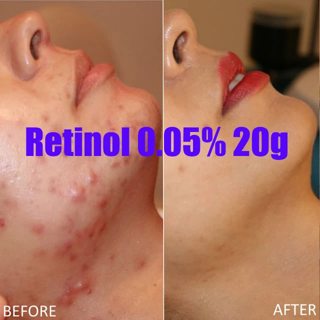 vitamin a topical for acne