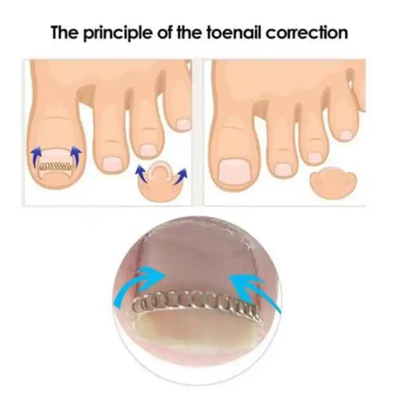 12pcs Ingrown Toe Nail Correction Wire Fixer Pedicure Paronychia Recover Toenails  Corrector Foot Care Tool|Foot Care Tool| - AliExpress