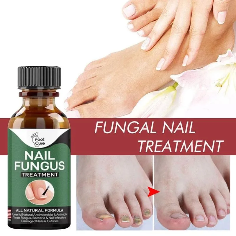 30ml Fungal Nail Repair Essence Toenail eliminación de hongos Gel Anti infección paronichia onicomicosis reparación tratamiento Serum cuidado