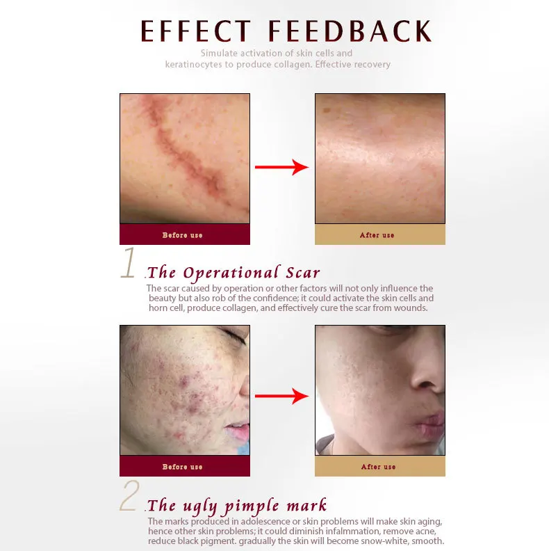 scar-ance-removal-gel_08