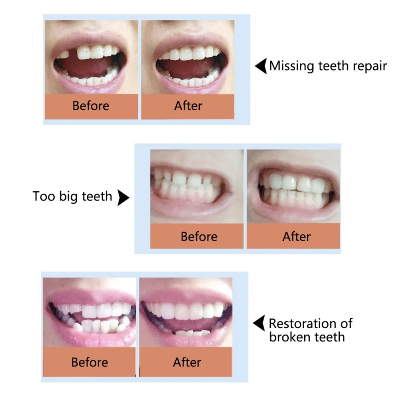 Набор для ремонта ложных зубов, твердый клей, временные зубные протезы, инструменты стоматолога, цельный клей