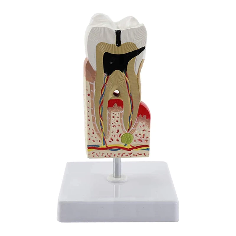Tooth Pathological Disease Caries Medical Science Teaching Resources