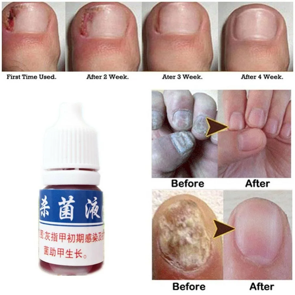 10 мл Лечение грибка для ногтей губит 99.9% бактерий противогрибковые инфекция ногтей Удаление грибок ногтей Лечение онихомикоза