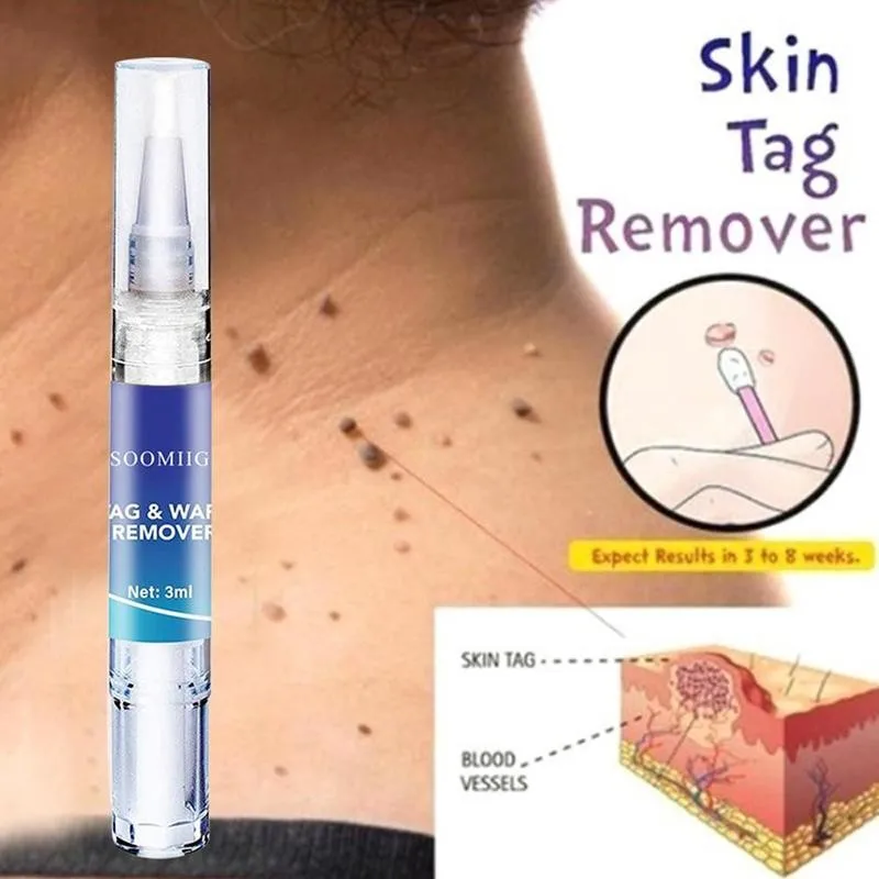 3ml Liquid Genital Wart Treatment Papillomas Removal Of Warts Skin Tags Removing Against Moles Remover Anti Verruca Remedy | Красота и