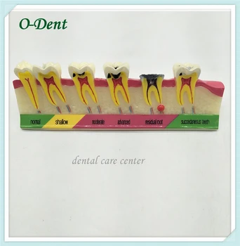 

Dental caries Teeth Model for root cannal endodontics Periodontal pathological Diseases Assorting Pathology Tooth comparation