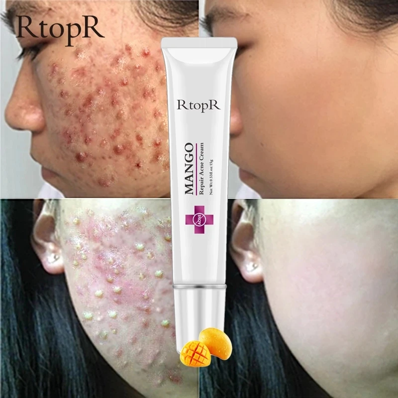 

RtopR Anti Acne Face Cream Pimple Removal Spots Repair Gel Oil Control Shrink Pores Scar Whitening Moisturizing Face Skin Care
