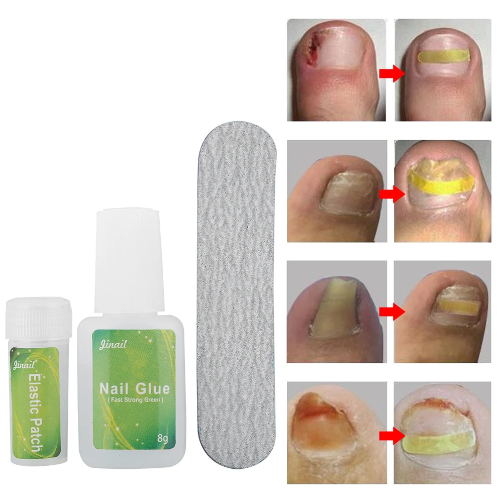 12/24Pcs Ingrown Physical Toenail Correction Patches Nail Pedicure Elastic Patch Straightening Clip Brace Bunion Corrector Tool