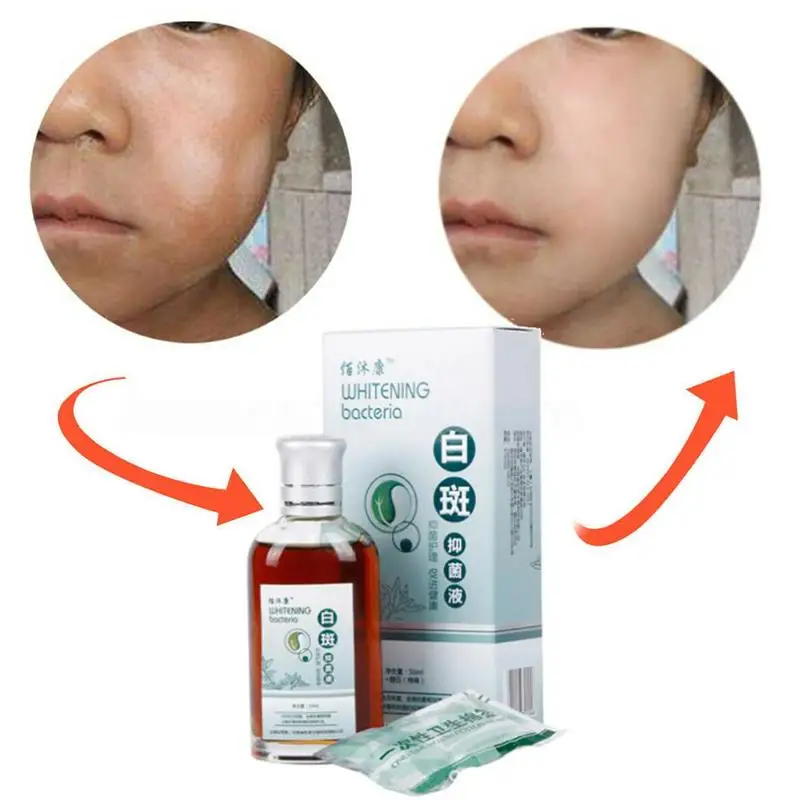 

50ml Skin Treatment White Spot Disease Remover Liquid Pigment Melanin Promoting Liniment Skin Vitiligo Leukoplakia Treatment