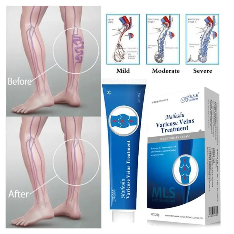 Spider крем против варикозного расширения вен мазь для варикозных естественное