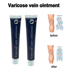 Крем для лечения варикозных вен, эффективное лечение васкулита, флебита, паука, боли в венах, варикозность, мазь для ангиита, забота о здоровье