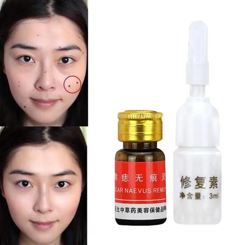 

Mole Removal Cream Freckle Removal Cream Professional Face Solution Solution Painless Repair Removal Care Treatment Acne H9D9