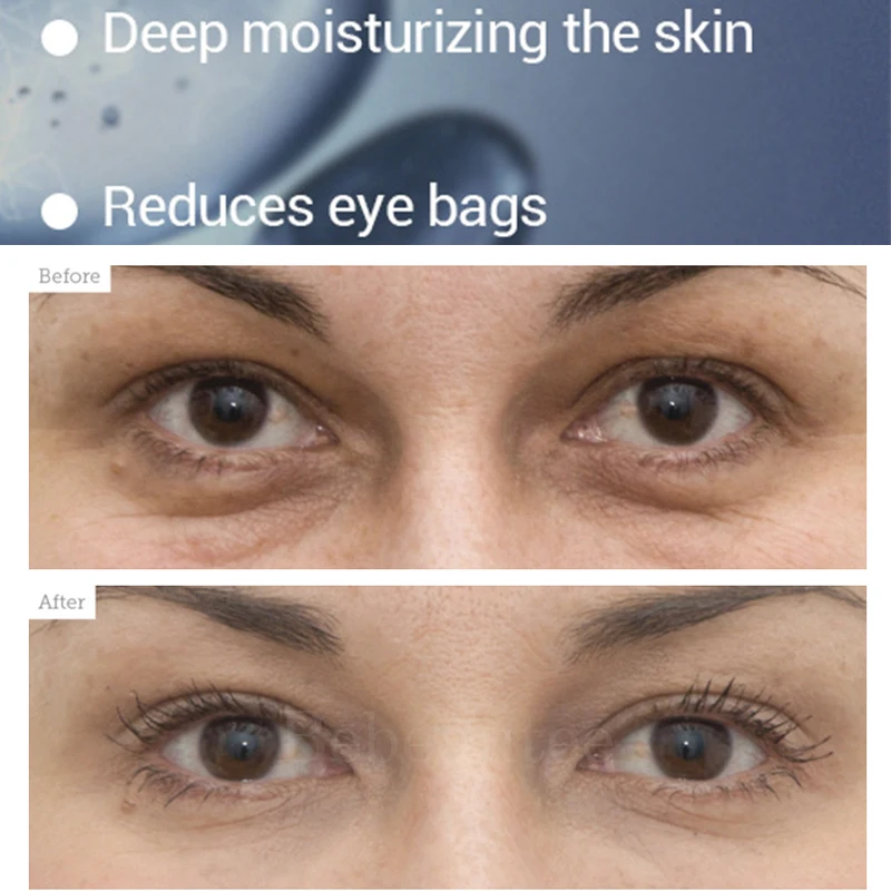 Lambena Patches for Eyes Masks Lanbena Retinol Anti-wrinkle Eye Patch Hyaluronic Acid Moisturizes Against Dark Circles Anti-dark